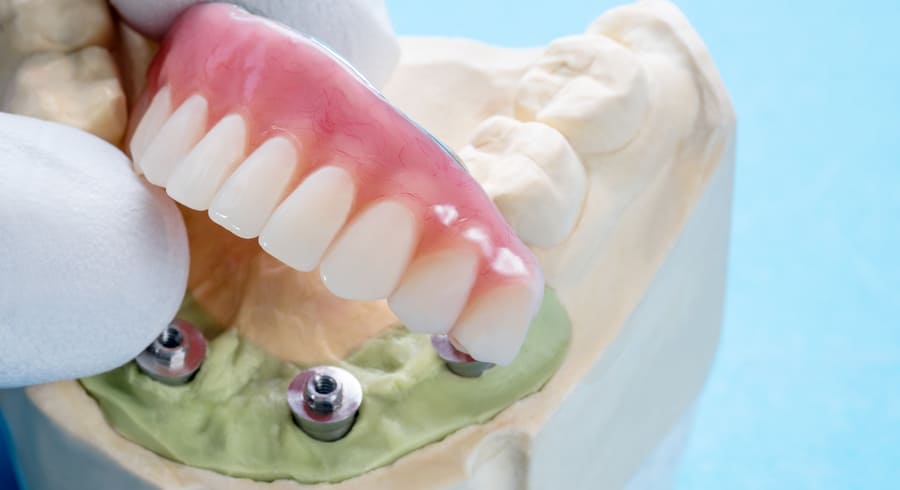 Стоматологов обучили нюансам препарирования фронтальных зубов - фотография