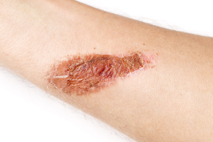 Ожог кожи: регенерация и восстановление | АМО — Академии медицинского  образования